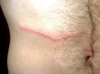 How to get rid of subcutaneous parasites in humans