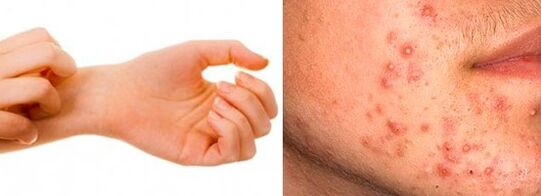 Symptoms of subcutaneous parasites in humans