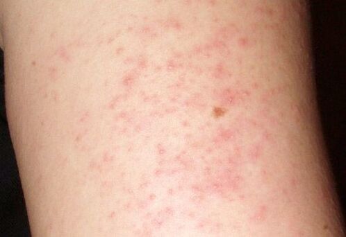 Itchy skin rashes are a symptom of the presence of worms in the liver.
