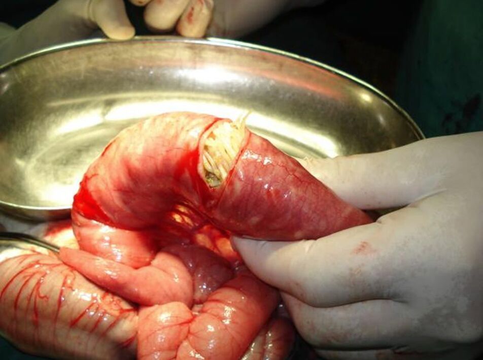 Roundworms in the human intestine.
